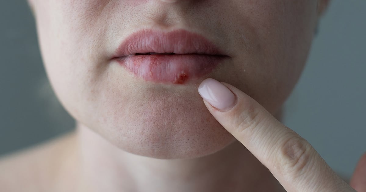 Herpes que no cedía: la FDA aprobó un antiviral oral inédito para los pacientes inmunocomprometidos de Argentina y el mundo