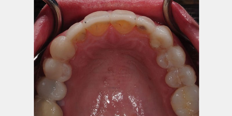 Carillas dentales: la filtración en los bordes puede abrir la puerta a caries yCOLOR